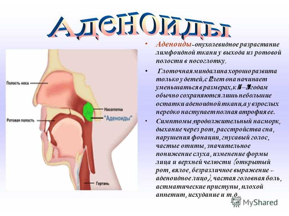 Аденоиды у детей — симптомы, причины и лечение