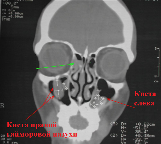 Киста верхнечелюстной пазухи: 8 важных фактов, которые необходимо знать