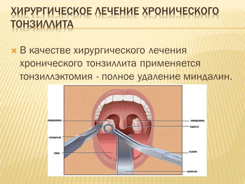 Вред после удаления гланд