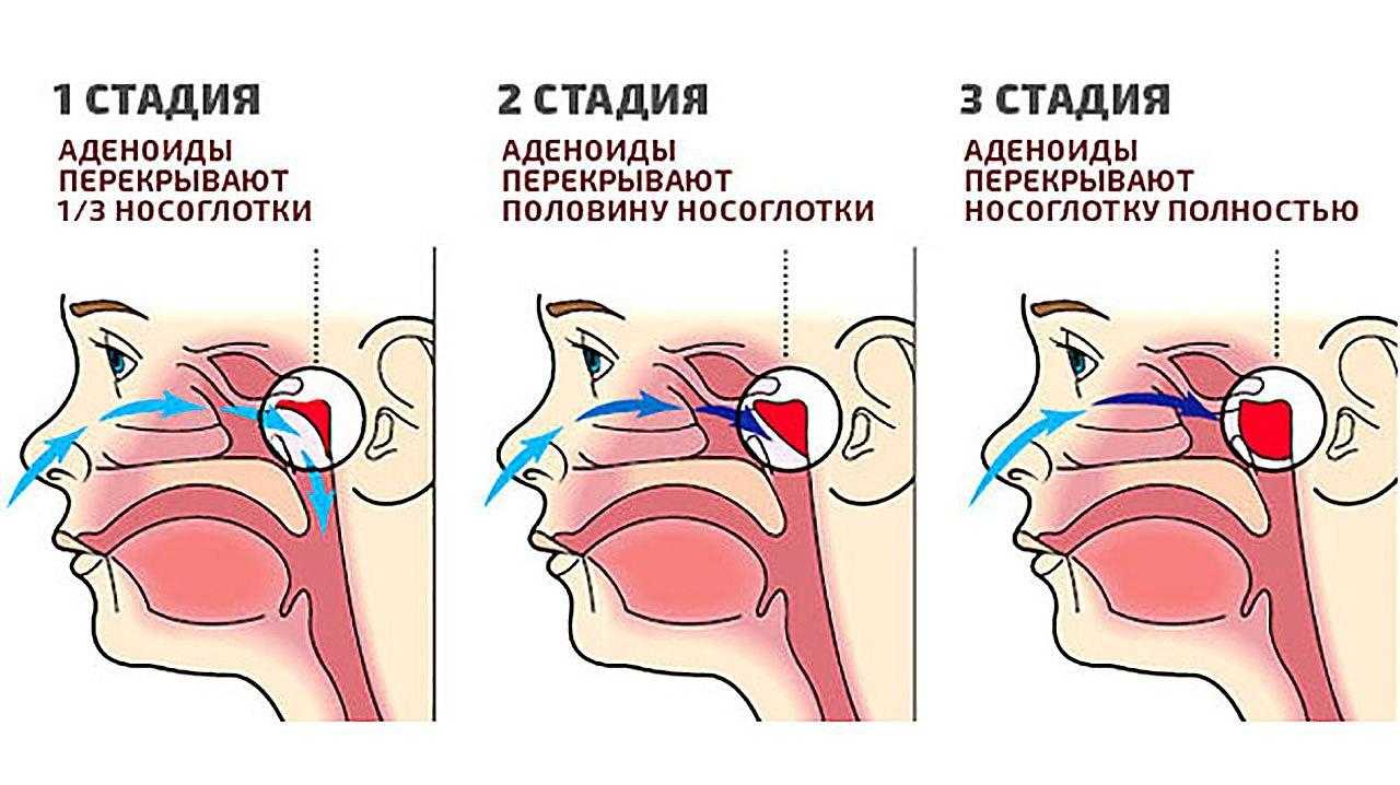 Аденоидит у детей - причины, симптомы, методы диагностики и лечения аденоидита