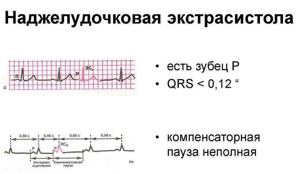 Экстрасистолическая аритмия: причины, симптомы, лечение