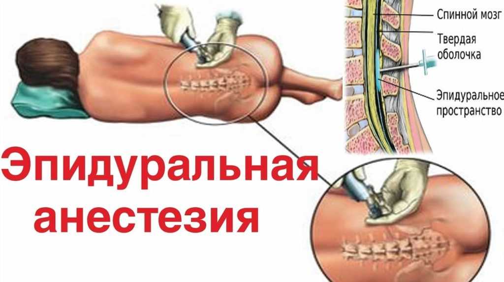 Болит спина после эпидуральной анестезии: что делать, лечение