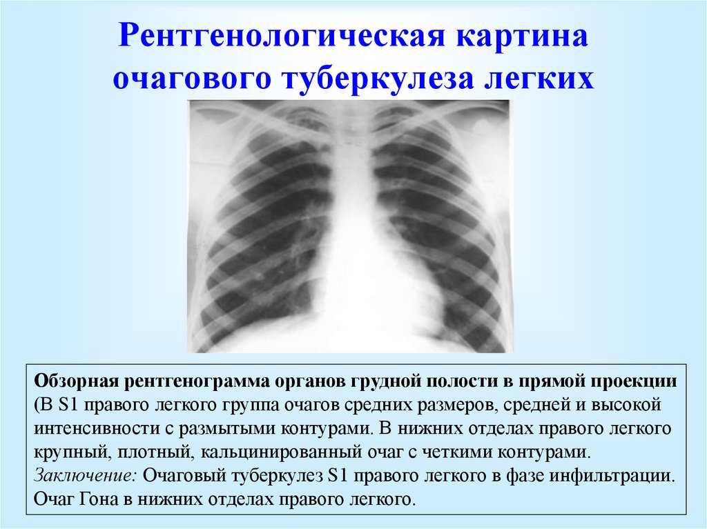 Туберкулез