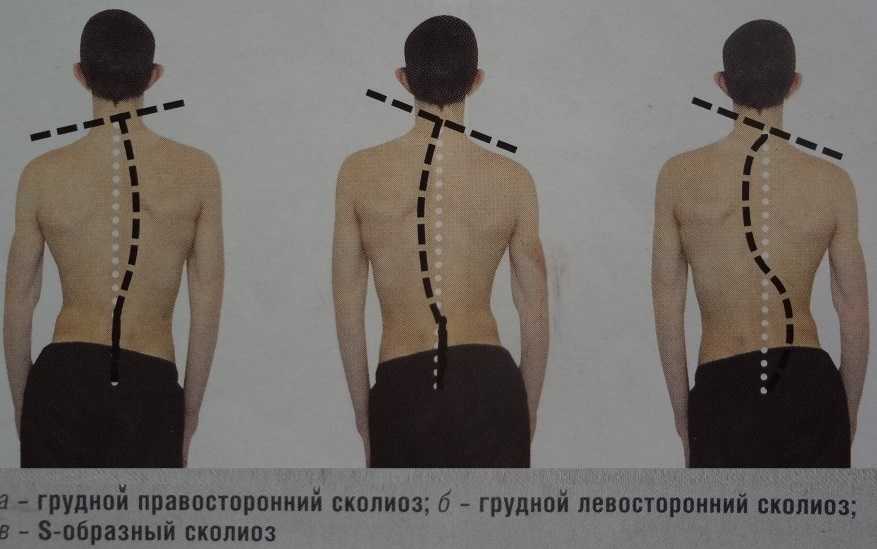 Сколиоз позвоночника - симптомы, причины, виды, степени и способы лечения
