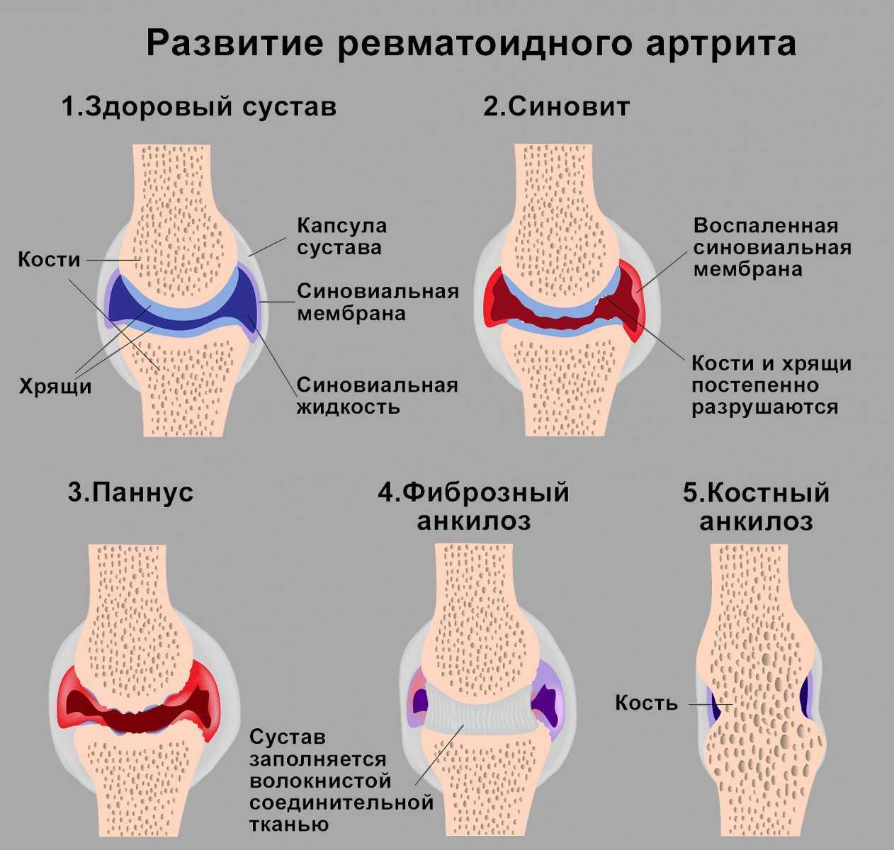 Артрит - к кому обратиться, виды, симптомы, диагностика