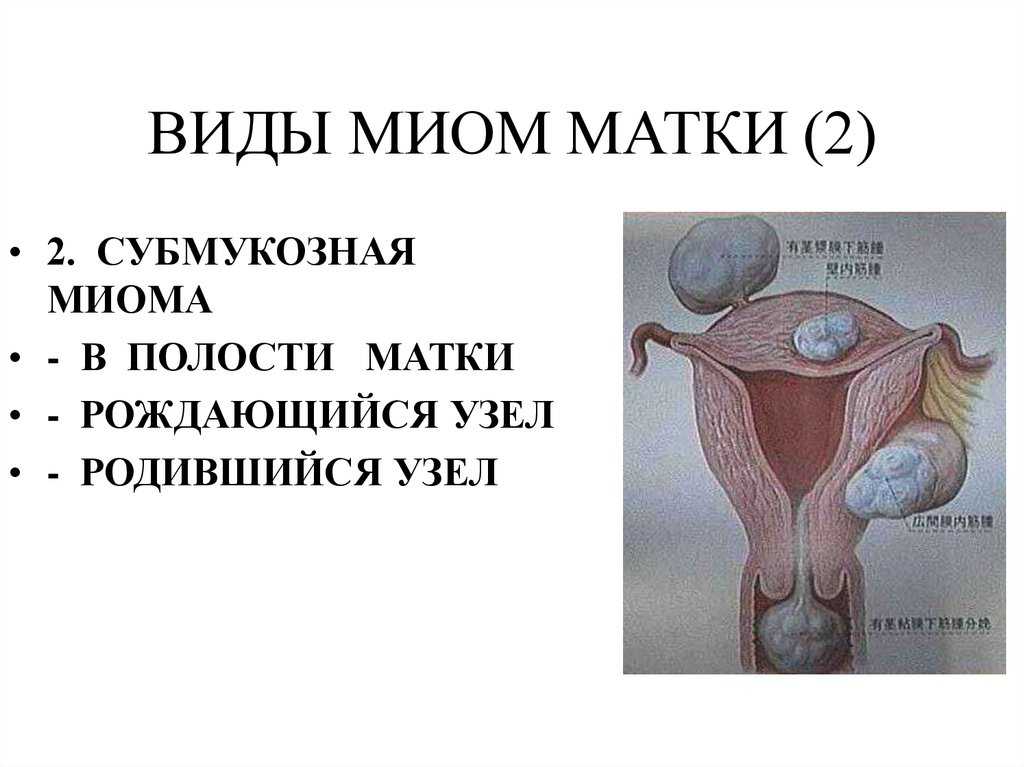 Удаление миомы матки различными методами: миомэктомия, эма, лапароскопия