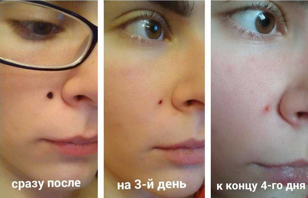 Удаление ксантелазмы век