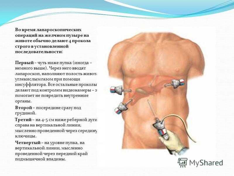 Жизнь после удаления желчного пузыря