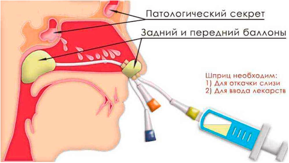 Все виды гайморита и варианты их лечения