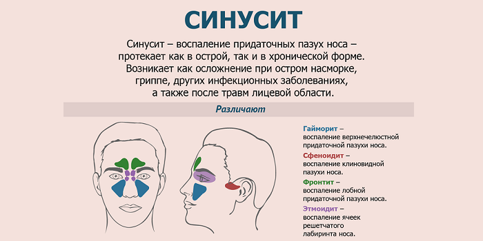 Риносинусит