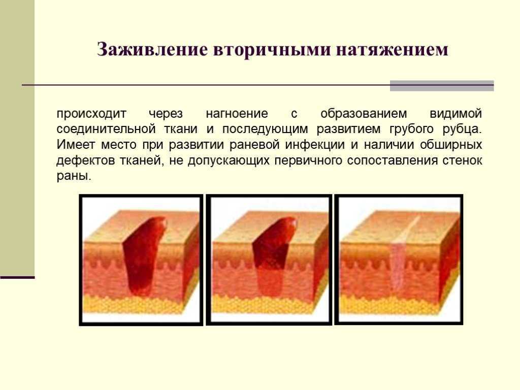 Хирургия гнойные раны. заживление раны и оптимальный рубец
