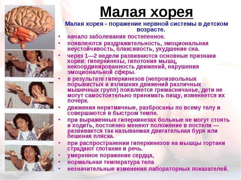 Малая хорея: причины, симптомы, диагностика и лечение