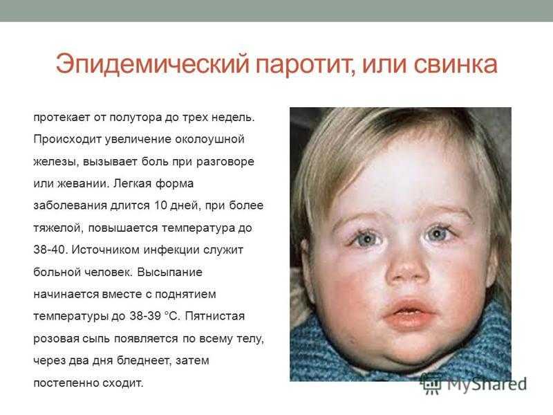 Эпидемический и неинфекционный паротит у детей: фото, симптомы и лечение