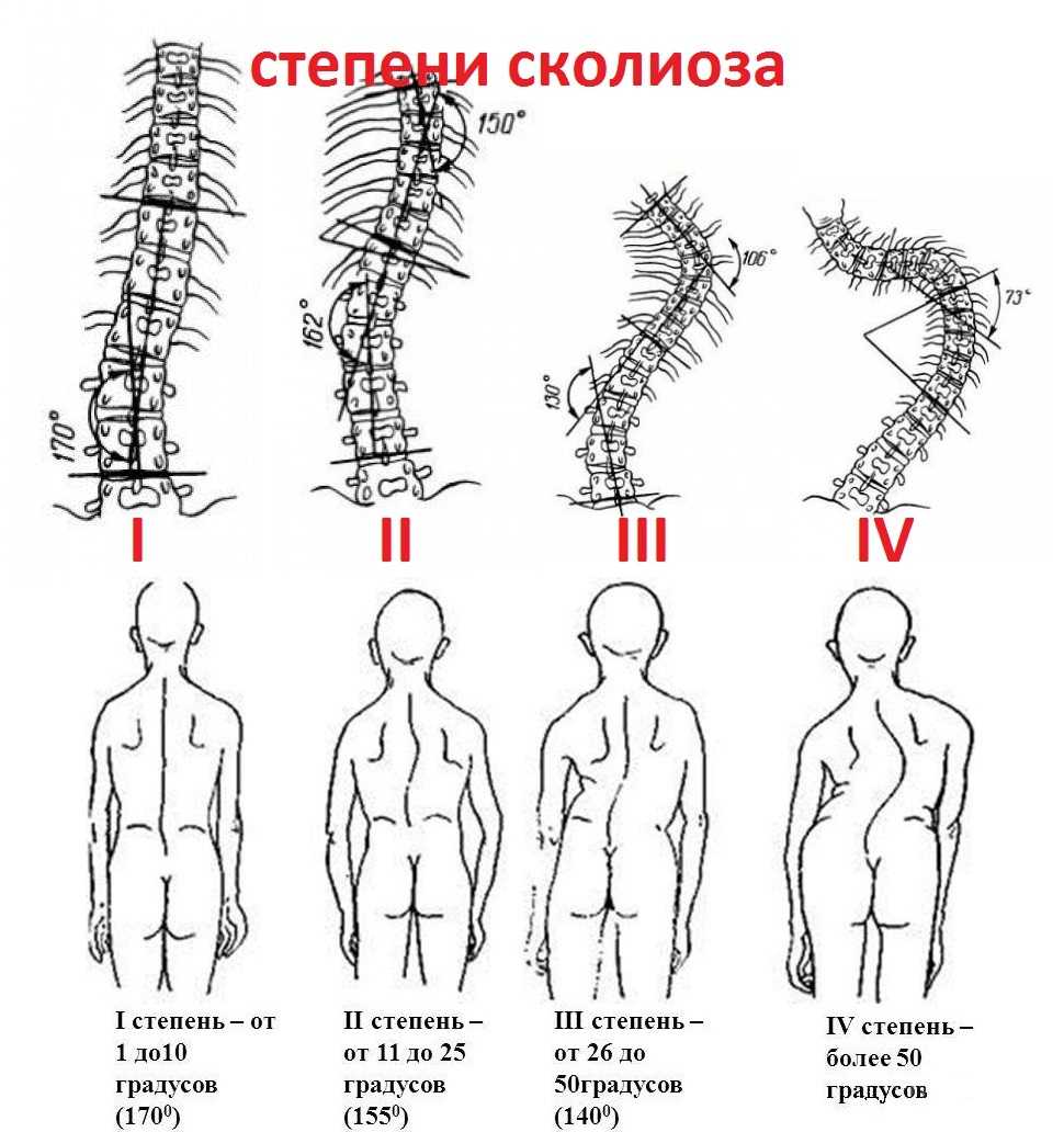 Характерные признаки грудопоясничного сколиоза  Грудопоясничный сколиоз  Нижнегрудной или грудопоясничный сколиоз объединяет в себе признаки патологического