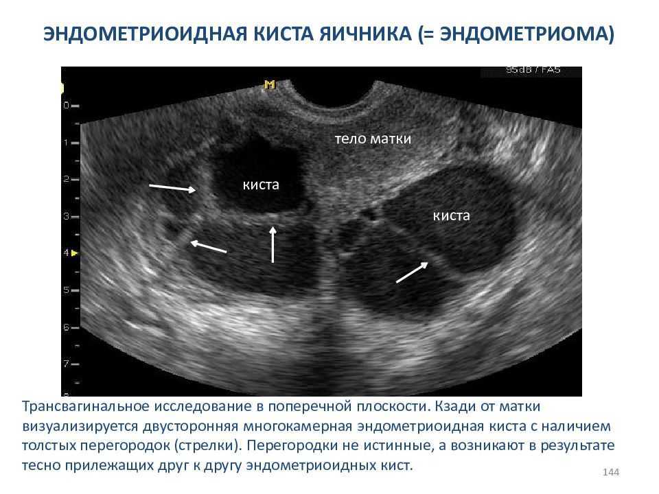 Фолликулярная киста и беременность  Беременность при фолликулярной кисте яичника  Фолликулярная киста яичника – это полостное доброкачественное образование,