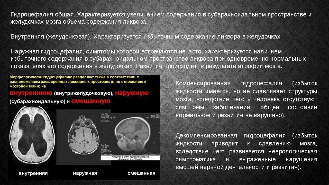 Гидроцефалия головного мозга на мрт  виды, признаки, заключение мрт при гидроцефалии