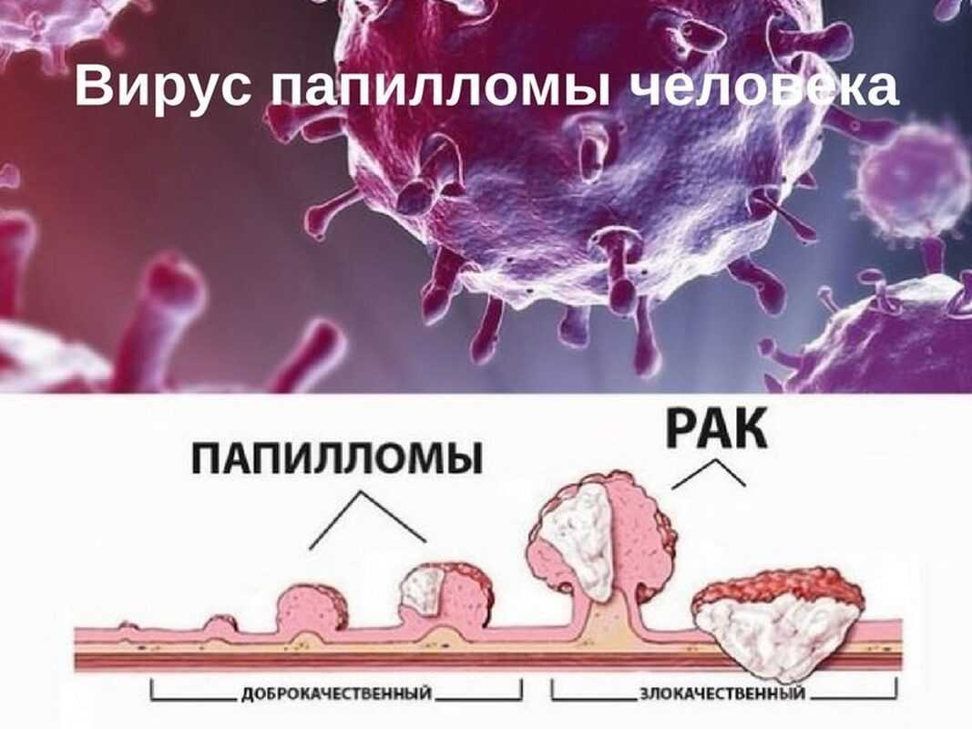 Впч, вирус папилломы человека: признаки, симптомы, лечение