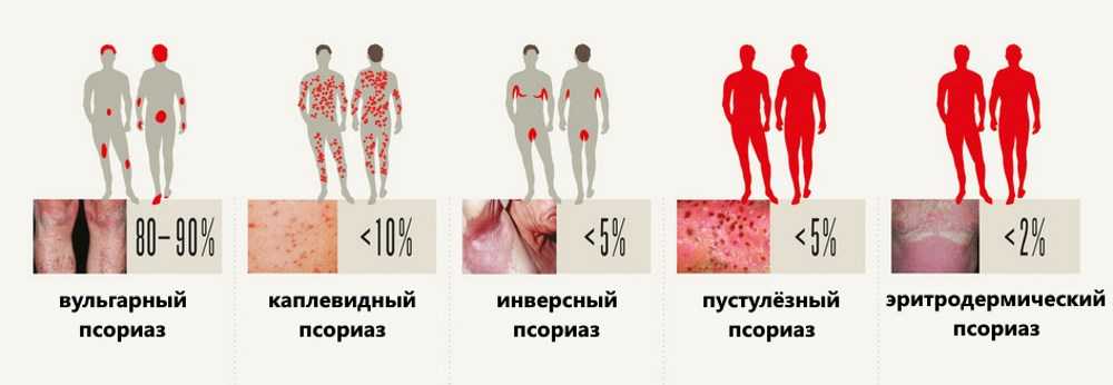 Герпетиформный дерматит дюринга: симптомы, лечение, диагностика