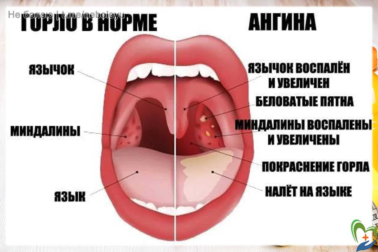Можно ли кормить грудью при ангине: влияние инфекции горла на молоко и ребёнка при кормлении