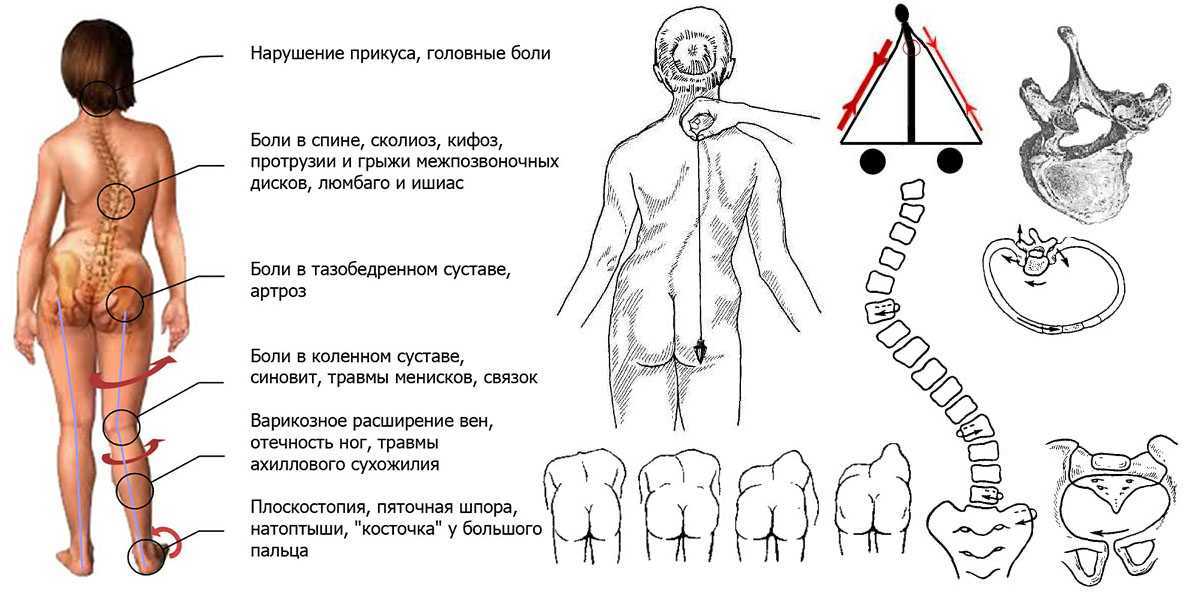 Сколиоз поясничного отдела позвоночника 1, 2 степени: причины, симптомы, лечение