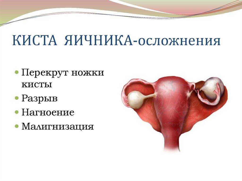 Киста желтого тела яичника правого и левого: симптомы и лечение при беременности, а также чем опасен разрыв с кровоизлиянием