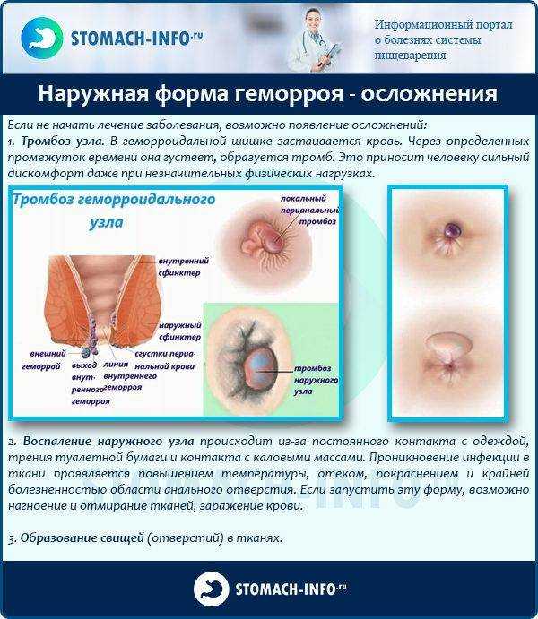 В заднем проходе как будто шевеление причины методы диагностика лечение рекомендации