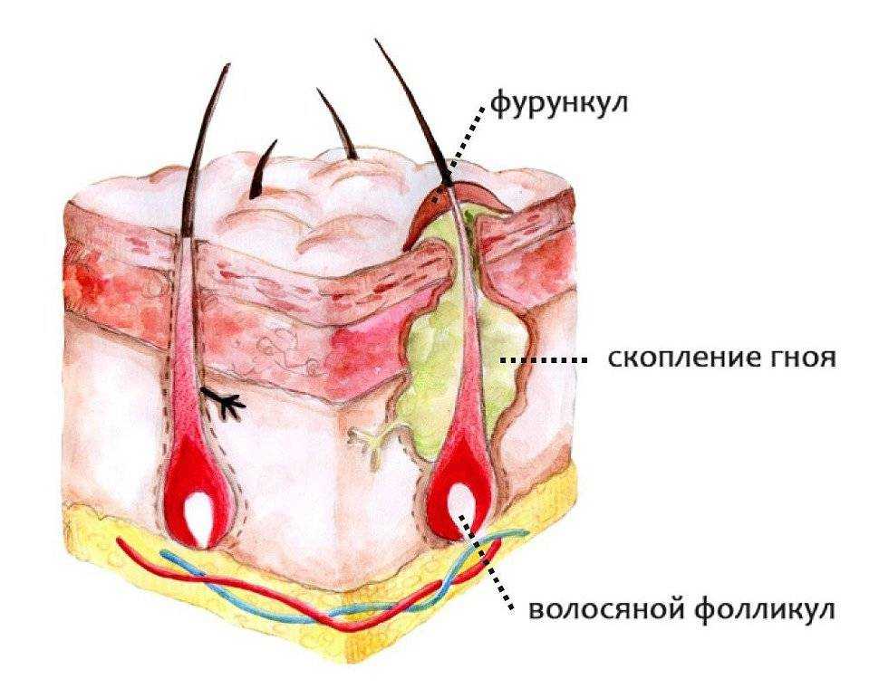 Воспалительные заболевания кожи