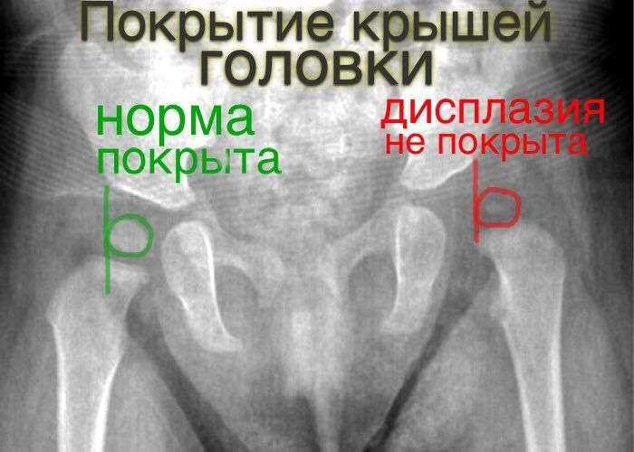 Узи тазобедренных суставов у грудничков: норма углов у новорожденных детей