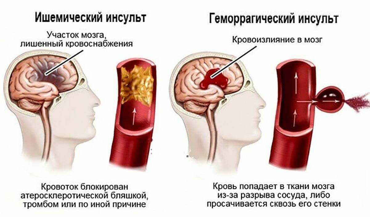 Современные подходы диагностики и лечения острого инсульта