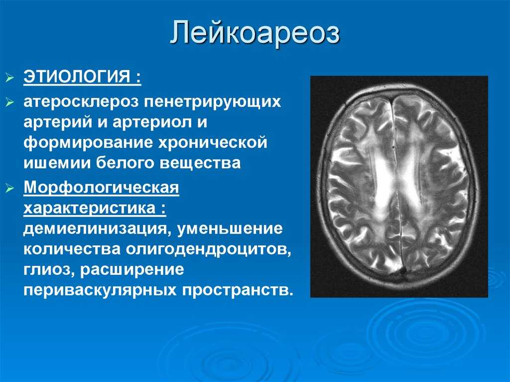 Лейкоареоз – цереброваскулярные заболевания | институт киари, cирингомиелии и cколиозa