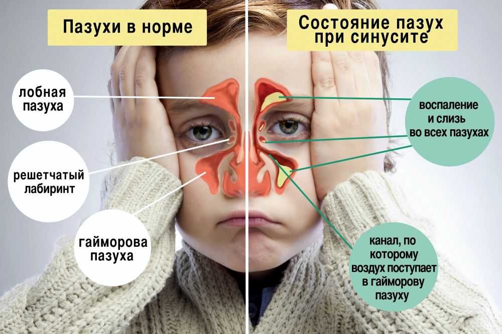 Что такое нарушение пневматизации верхнечелюстных пазух носа