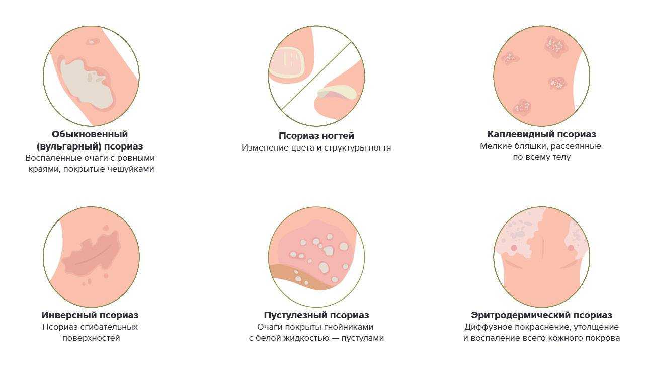 Розовый лишай у человека (питиаз) – лучшие средства для лечения