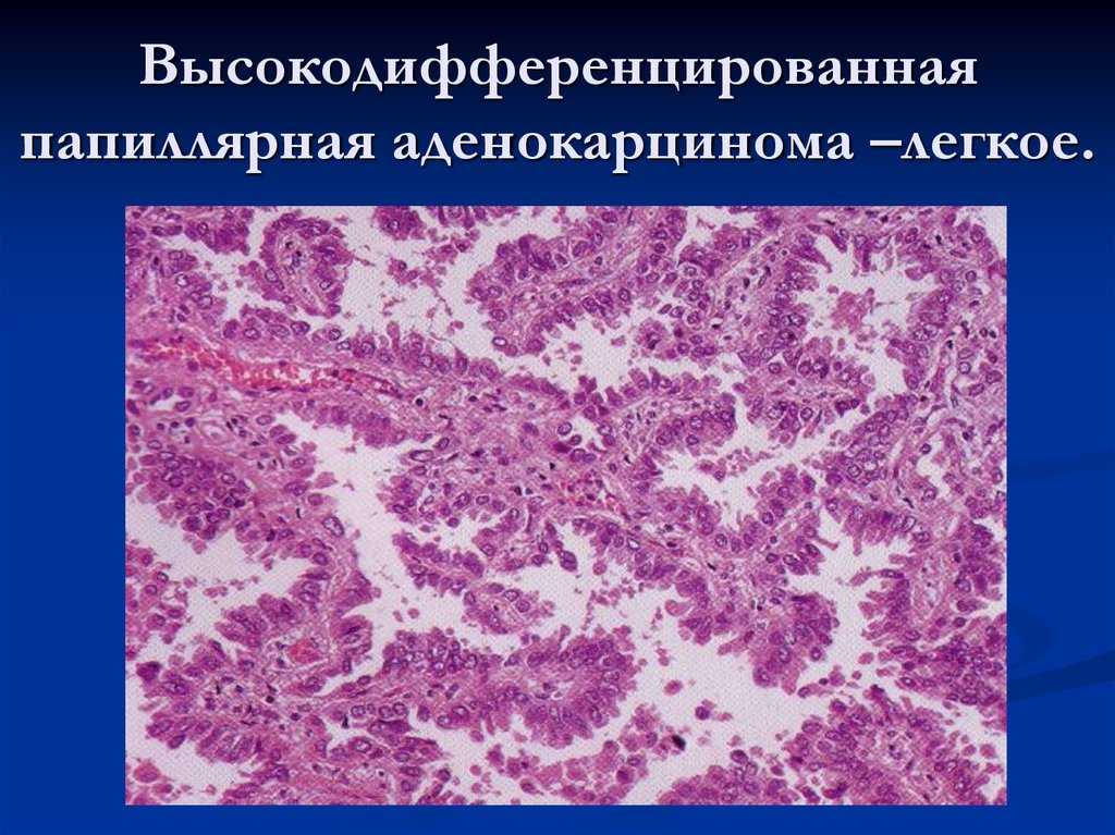 Низкодифференцированная аденокарцинома: какие органы поражает