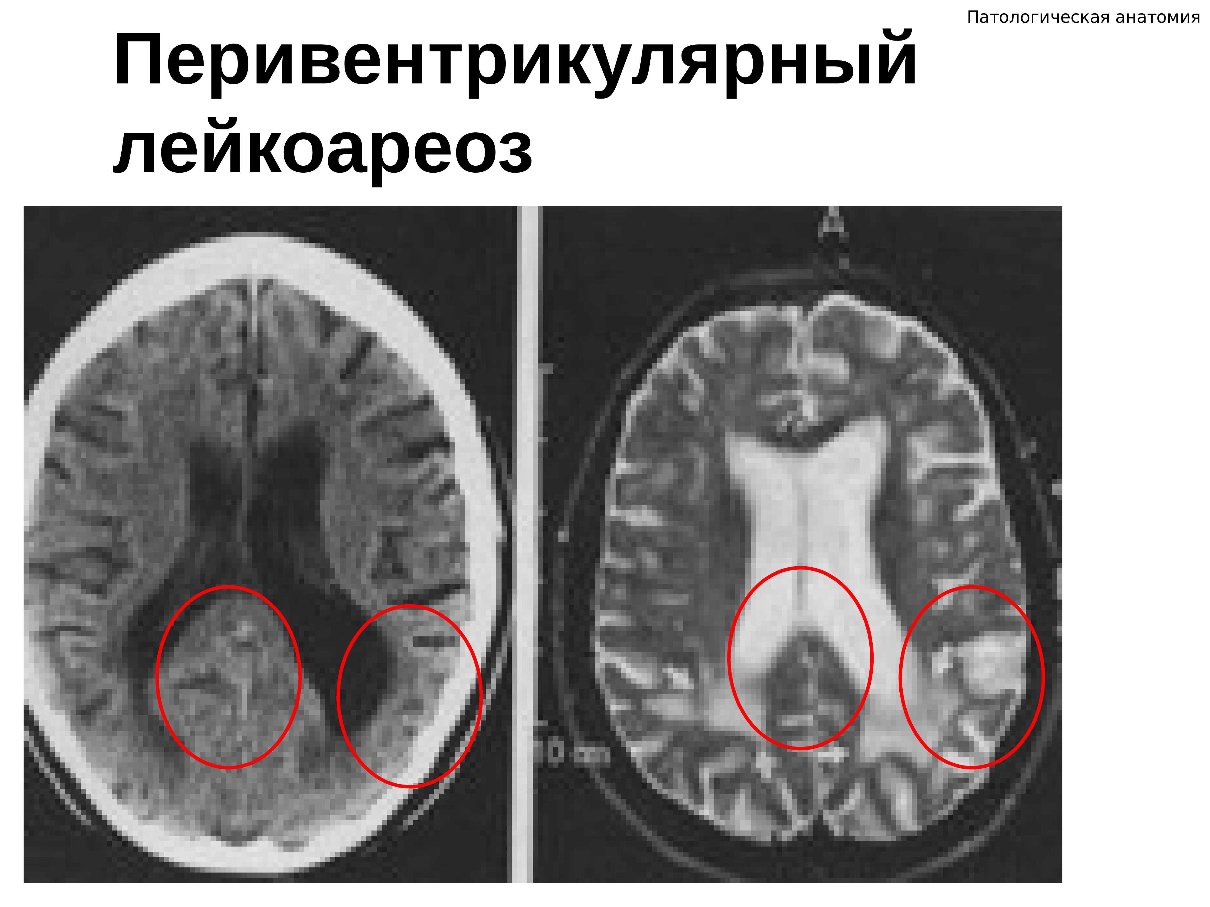 Что это такое лейкоареоз головного мозга: симптомы, лечение, профилактика