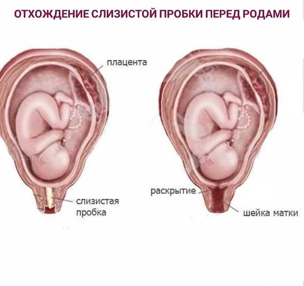Отхождение пробки перед родами: что это и за сколько времени отходит? - умкамама.ру