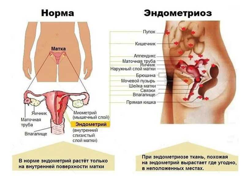 Диета при эндометриозе матки: каким должно быть питание, что нельзя есть и как составить меню + помогают ли упражнения и йога