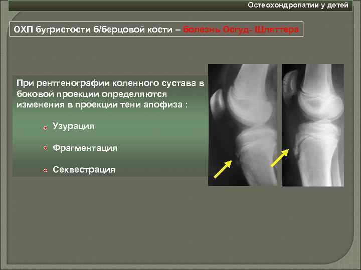 Болезнь осгуда-шляттера коленного сустава у подростков, взрослых и детей
