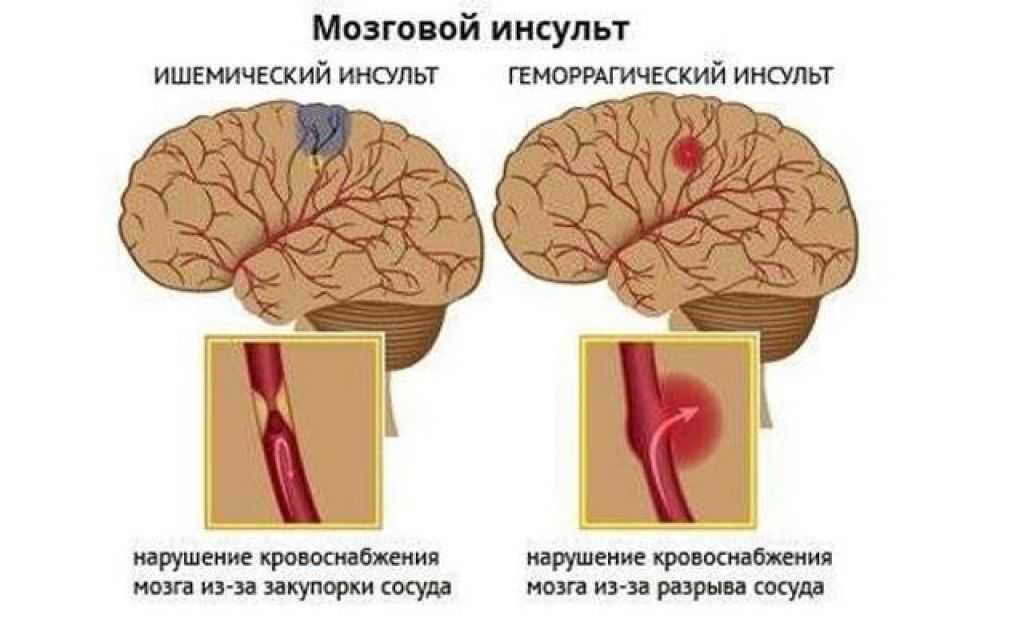 Что такое геморрагический инсульт