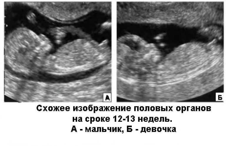 Пол ребенка на узи: на каком месяце и неделе можно узнать, может ли ультразвук ошибиться, вместе с народными приметами, что видно на фото