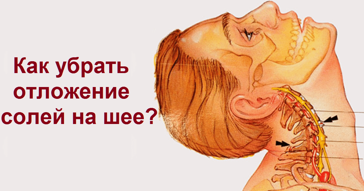 Как убрать холку на шее: методы массажа и упражнений