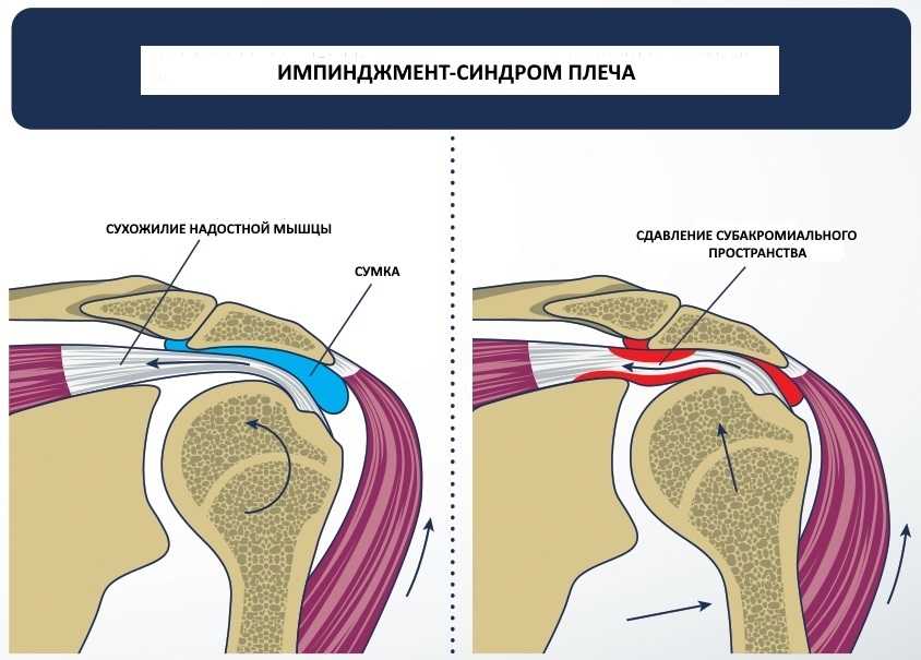 Болезнь гоффа - симптомы, диагностика и лечение