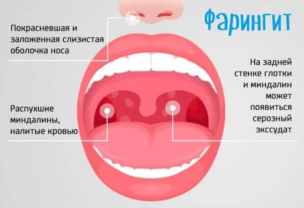 Боль в горле с одной стороны: причины и особенности их проявления, диагностика, терапия