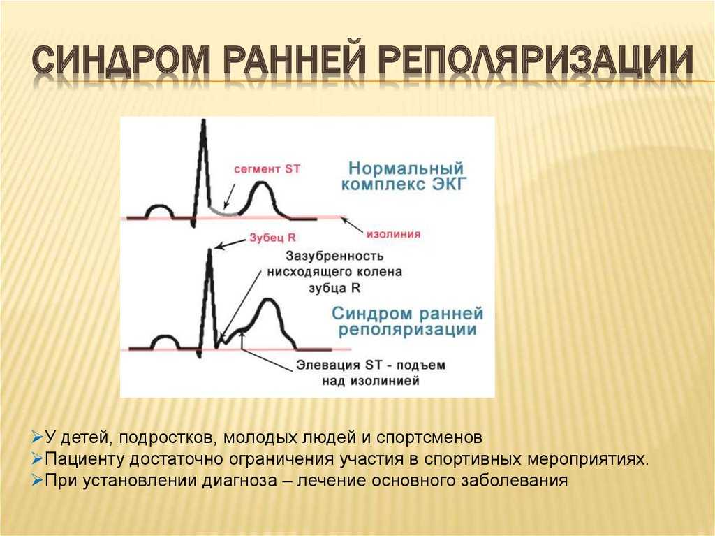Нарушение процессов реполяризации на экг у взрослых и детей