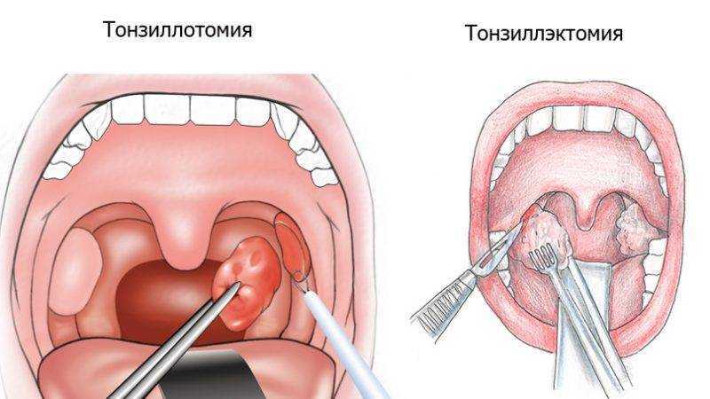 Криодеструкция миндалин: криотерапия и прижигание жидким азотом