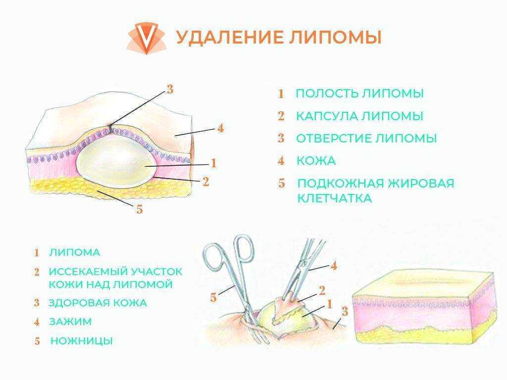 Липома на голове: удаление, профилактика