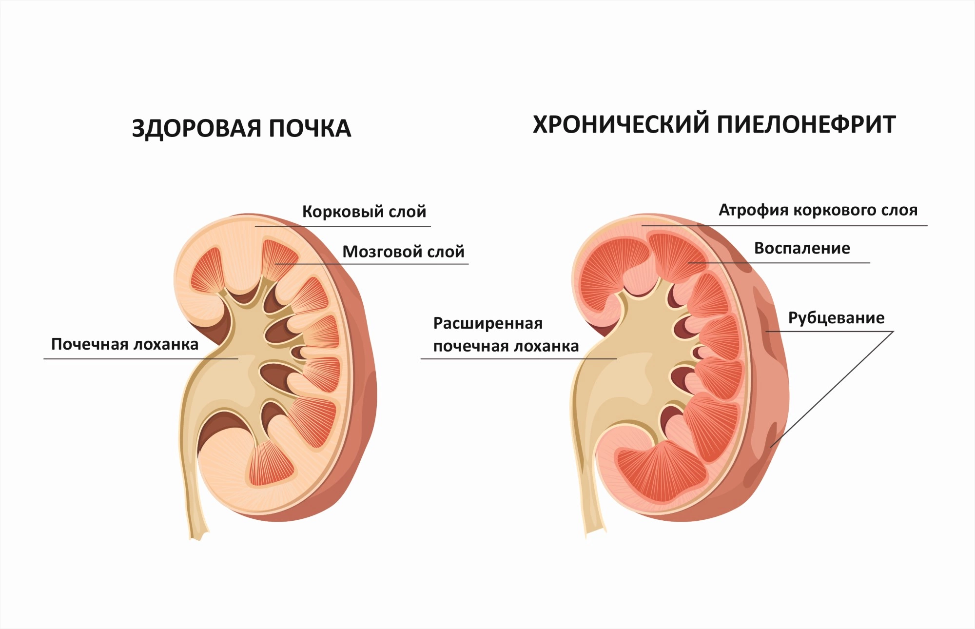 Гидрокаликоз почек у детей и взрослых - юнлидент