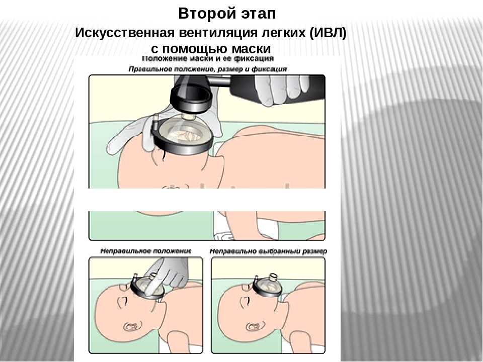 Ателектаз легкого: причины, 5 ведущих симптомов, 10 принципов лечения