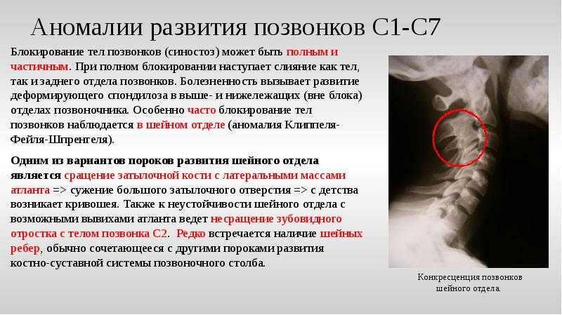 Стеноз шейного отдела позвоночника