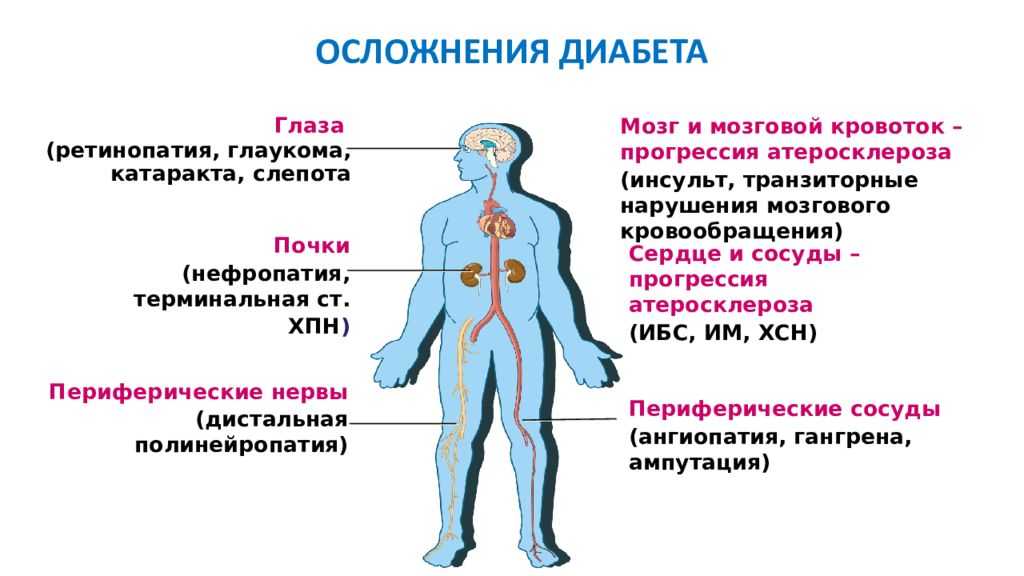 Сахарный диабет