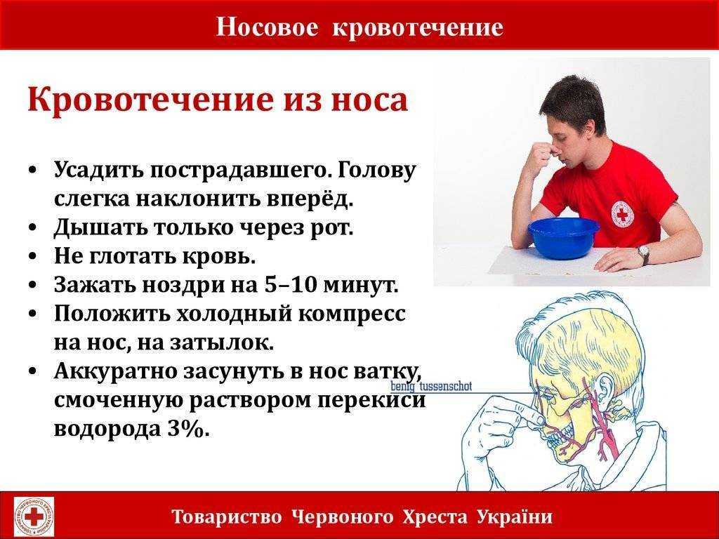 Кровь из носа у ребенка: почему возникает кровотечение и что нельзя делать оказывая первую помощь